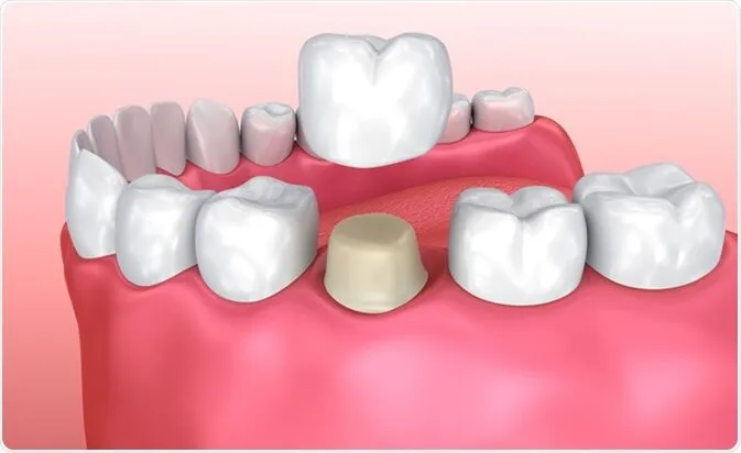 Dental Crowns