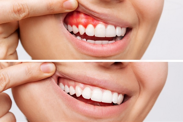 Gums Treatment